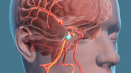 Cirugía cerebrovascular